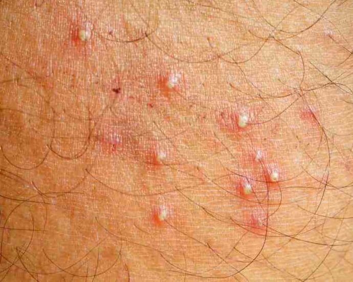 Folliculitis