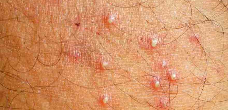 Folliculitis