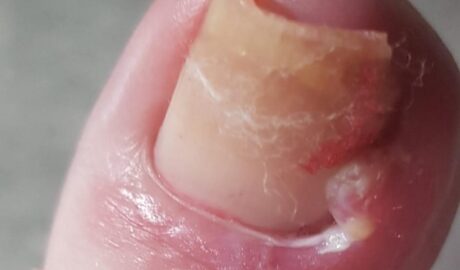 Ingrown Toenail