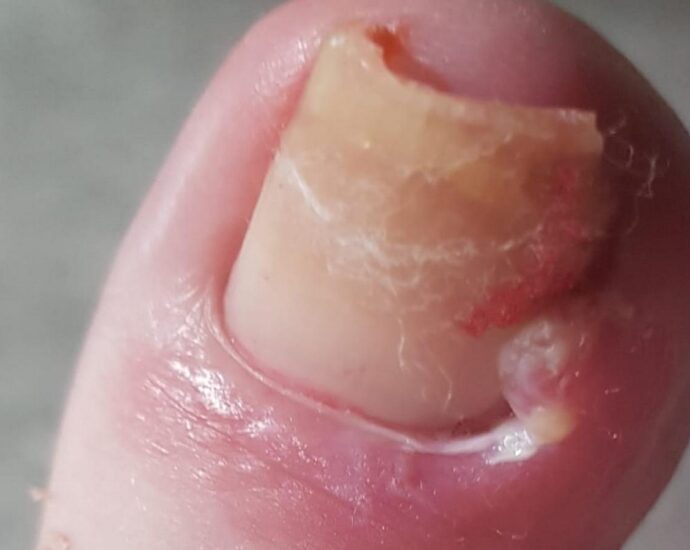 Ingrown Toenail