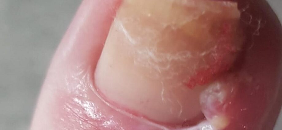 Ingrown Toenail