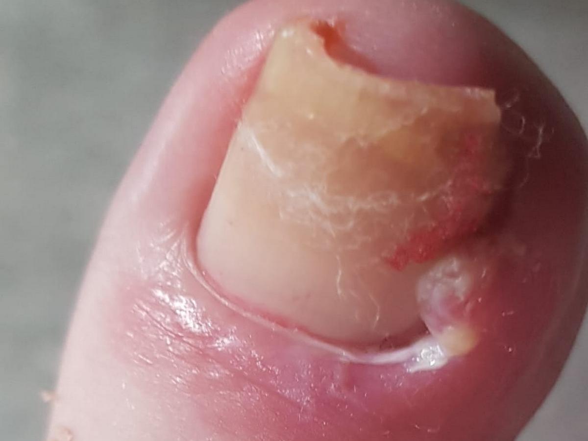 Ingrown Toenail